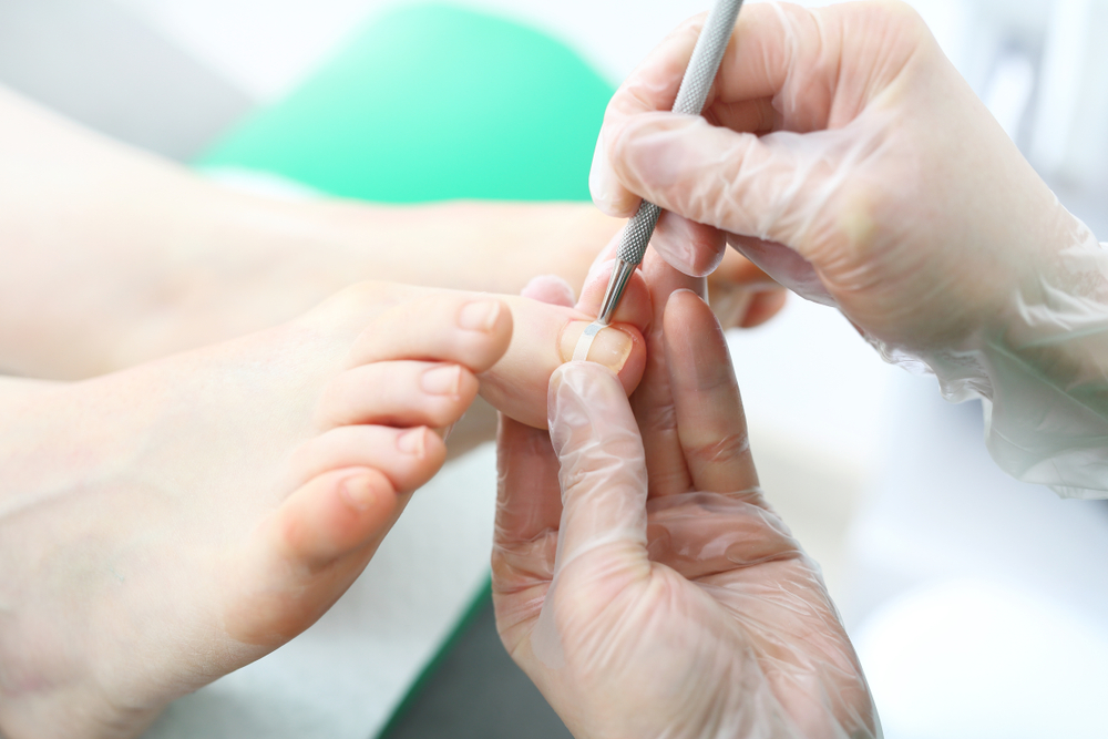 Podology,Clasp.,The,Surgeon,Puts,A,Clamp,On,An,Ingrown Fußpflege St. Georgen - spangentechnik